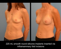breast-augmentation5