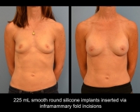 breast-augmentation6