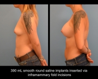 breast-augmentation7