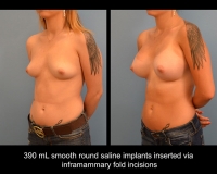 breast-augmentation8