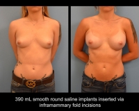 breast-augmentation9