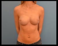 Breast-Reconstruction-7