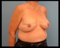 Breast-Reconstruction11