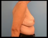 Breast-Reconstruction12