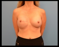 Breast-Reconstruction12a