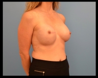 Breast-Reconstruction13