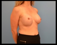 Breast-Reconstruction13