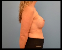 Breast-Reconstruction14