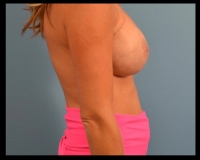 Breast-Reconstruction17