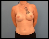 Breast-Reconstruction21