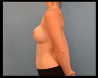 Breast-Reconstruction23
