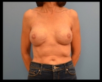 Breast-Reconstruction24