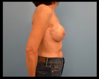 Breast-Reconstruction26