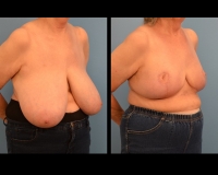 breast-reduction10