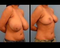 breast-reduction2