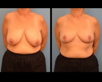 breast-reduction24