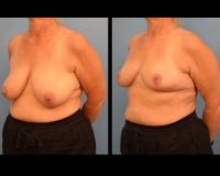 breast-reduction25