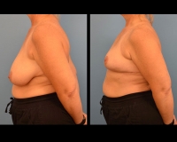 breast-reduction26