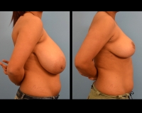breast-reduction3