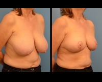breast-reduction5