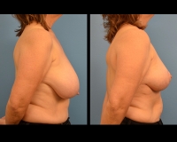 breast-reduction6