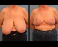 breast-reduction9