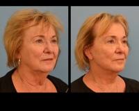 ThirdRowFacelift2